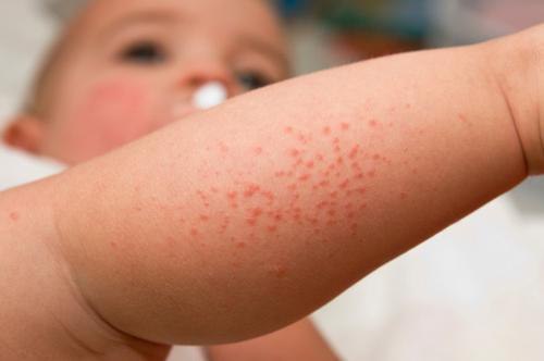 Средство против аллергических высыпаний на коже ребенка