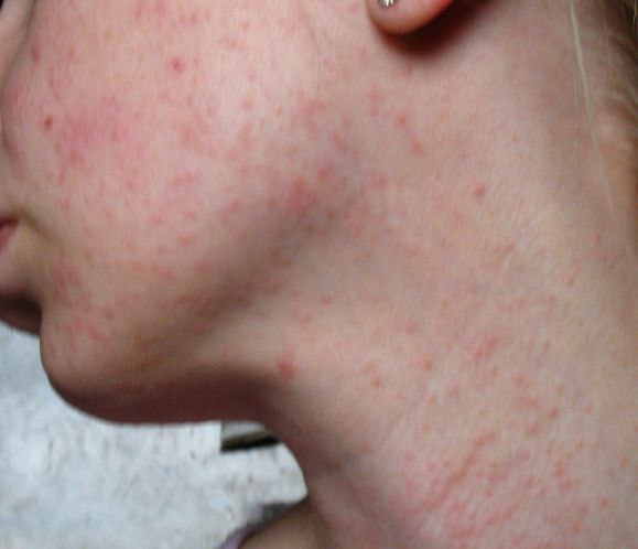 Средство против аллергических высыпаний на коже ребенка