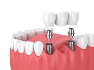 Важность имплантации зубов