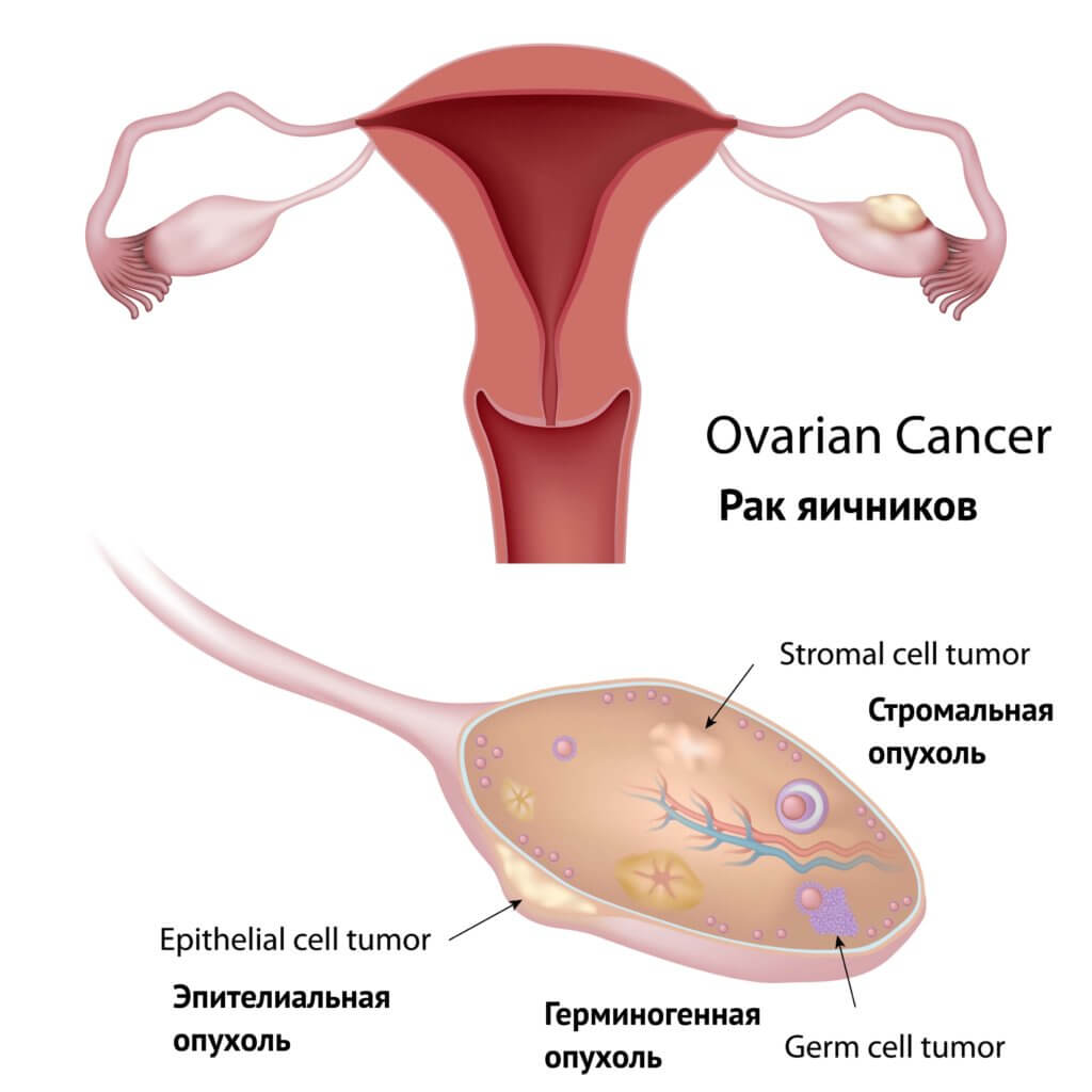 Как лечат рак яичников?