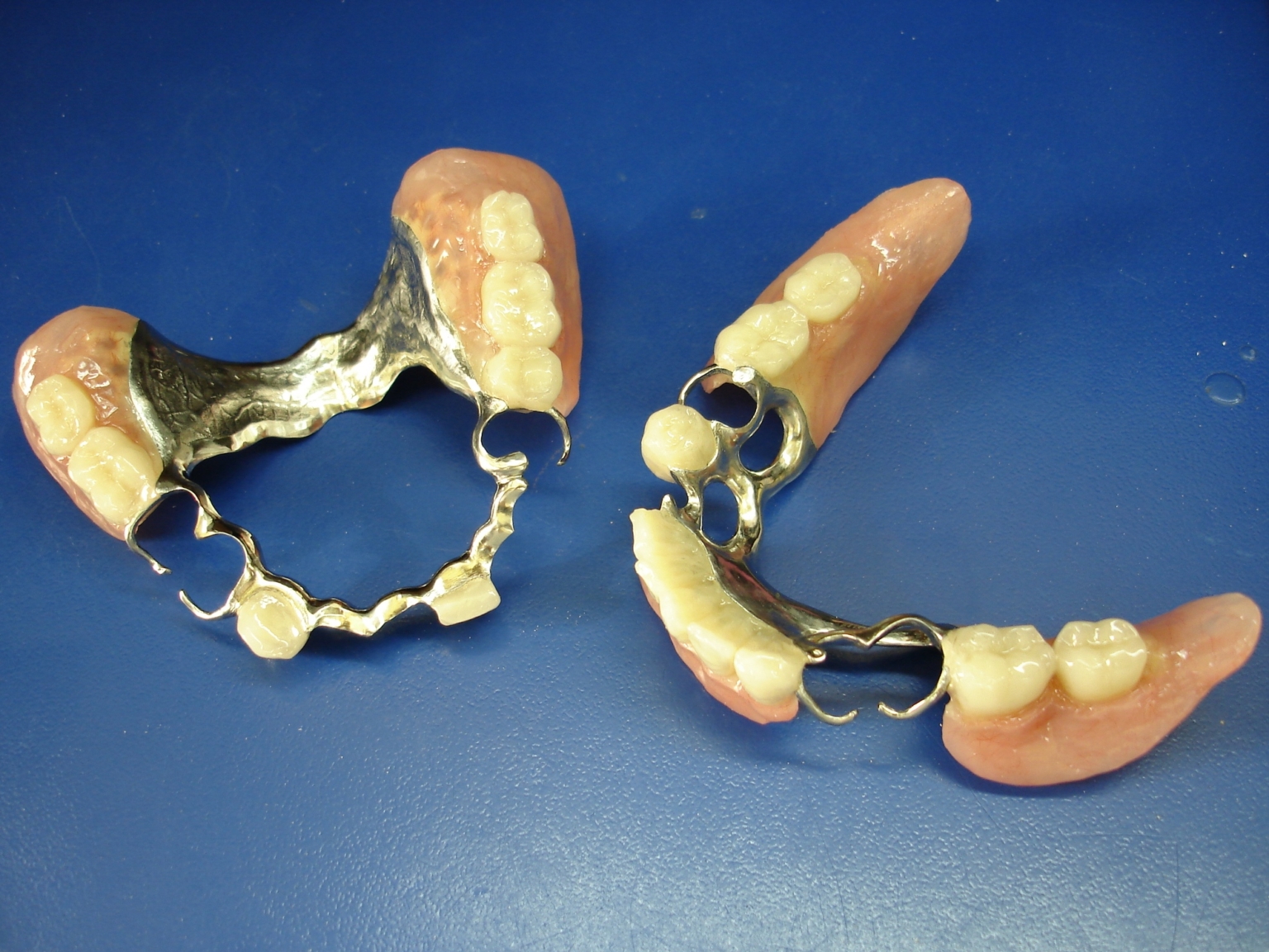 Что такое бюгельный протез зубов?
